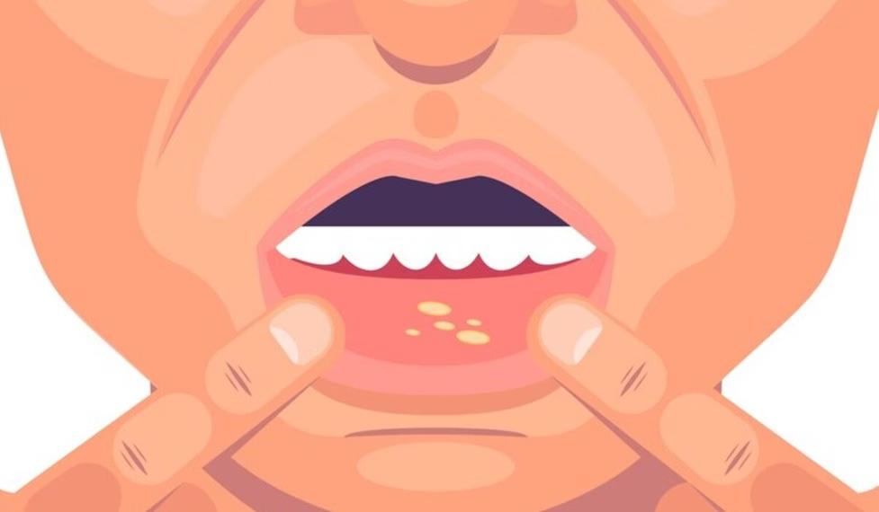 Waspada! Ketahui Gejala HIV/AIDS Setelah Berhubungan