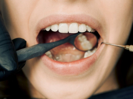 Solusi Ampuh Atasi Karang Gigi Membandel