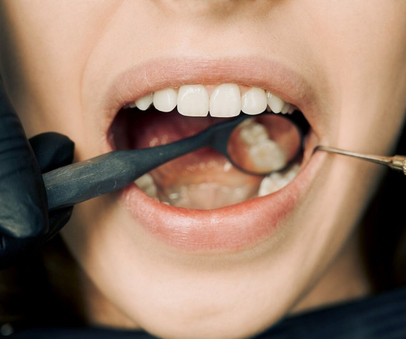 Solusi Ampuh Atasi Karang Gigi Membandel