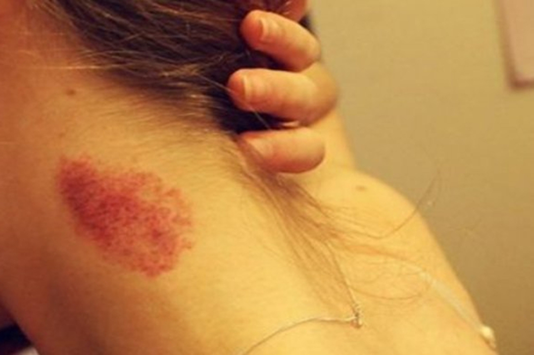 Cupang di Leher, Nikmat Namun Berisiko